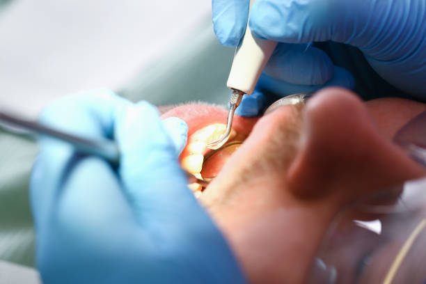 Best Emergency Root Canal Treatment in Fkville, AL