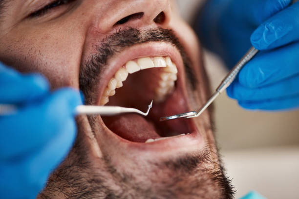 Best Emergency Dentist for Knocked-Out Tooth in Fkville, AL