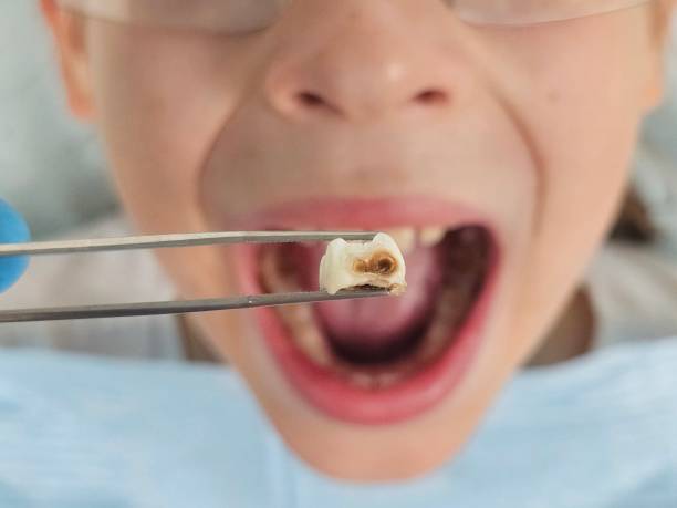 Best Emergency Dental Extractions in Fkville, AL